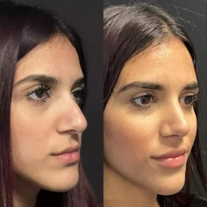 How Best Doctors in Dubai Treat Complex Septoplasty Cases
