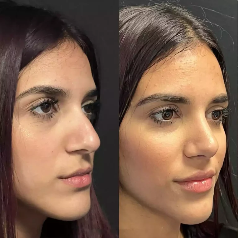 How Best Doctors in Dubai Treat Complex Septoplasty Cases
