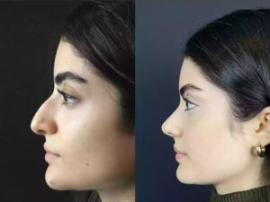 Best Doctors in Dubai Discuss Rhinoplasty for All Ages