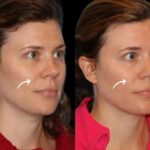 Sculptra Treatments in Dubai and Facial Storytelling
