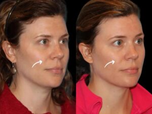 Sculptra Treatments in Dubai and Facial Storytelling