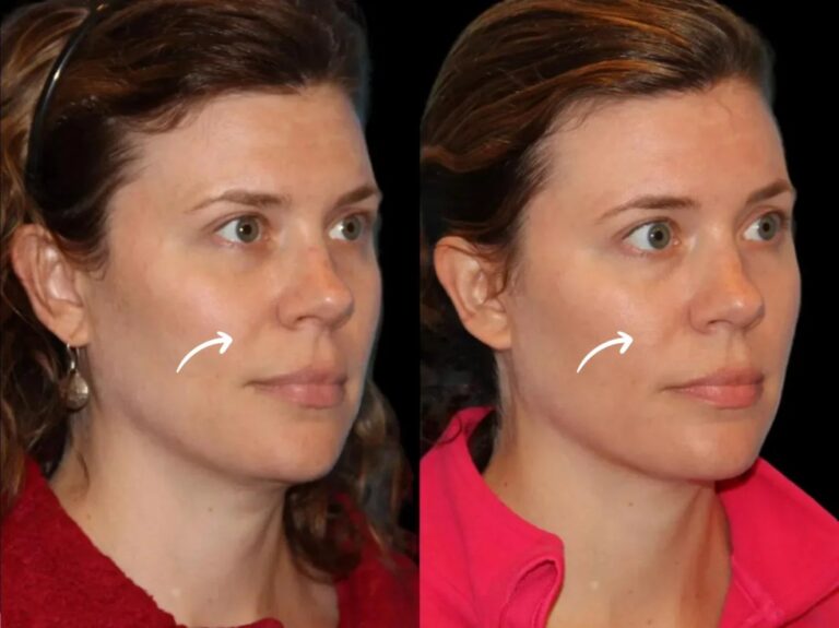 Sculptra Treatments in Dubai and Facial Storytelling