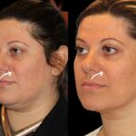 Sculptra Treatments in Dubai for Subtle Facial Changes