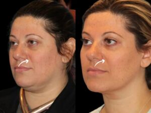 Sculptra Treatments in Dubai for Subtle Facial Changes