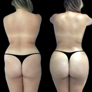 Best Doctors in Dubai for Hyacorp Body Contouring