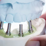 Achieve a Beautiful Smile with All-on-4 Implants: Fixed Teeth with Just Four Implants