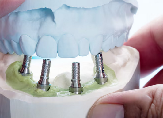Achieve a Beautiful Smile with All-on-4 Implants: Fixed Teeth with Just Four Implants