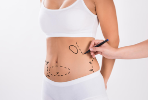 Liposuction Surgery in Dubai for Targeted Fat Removal and Body Enhancement