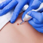 Can Mole Removal Be Customized?