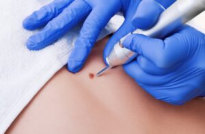 Can Mole Removal Be Customized?