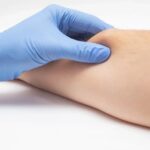 Signs That You May Need Lipoma Treatment