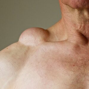 Can Exercise Replace Best Lipoma Treatment in Muscat?