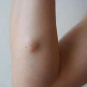 Can You Delay Lipoma Treatment Safely?